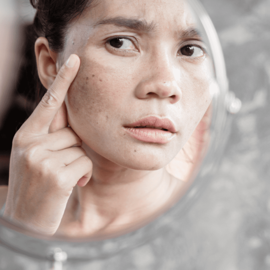 Melasma: Desvendando os Mistérios das Manchas na Pele